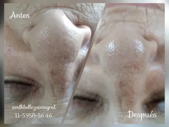 Limpieza de Cutis Profunda Caballito