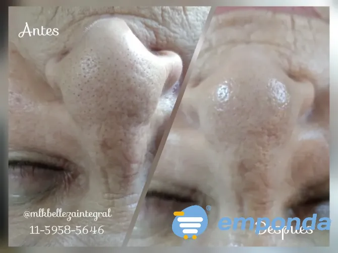 Limpieza de Cutis Profunda Caballito - imagen 1